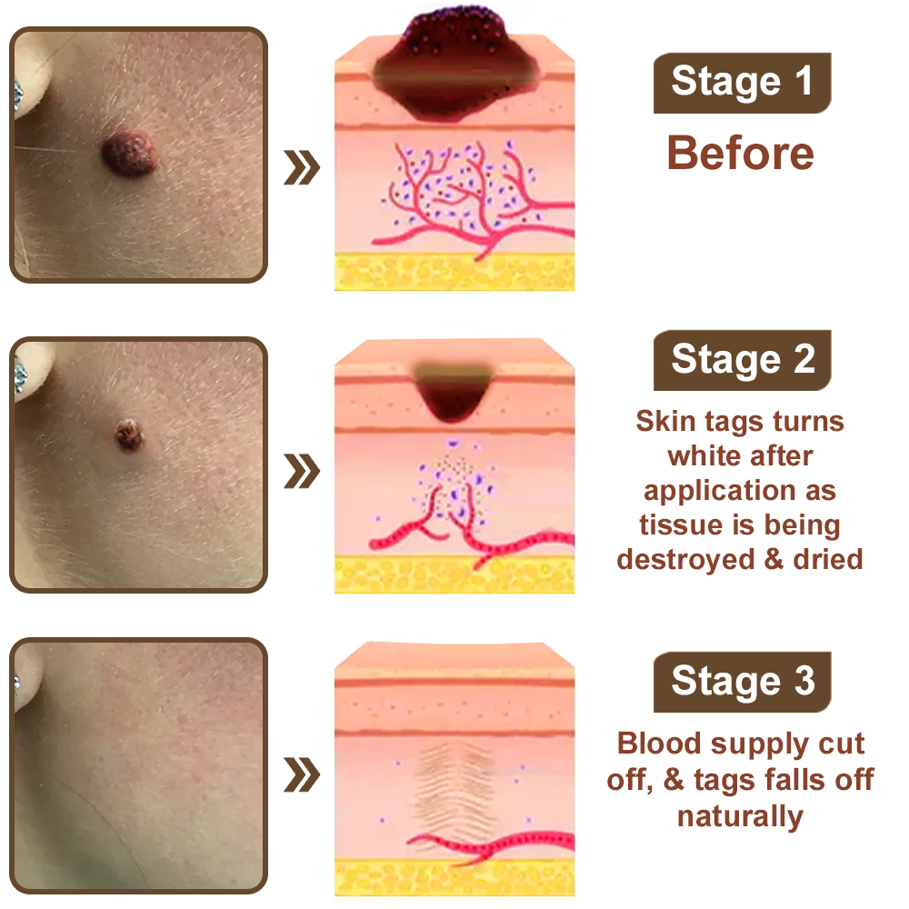 Black Rice Skin Repair Essence Cream ⚕️ FDA Certified (Removes warts and skin growths, improves keratin buildup and seborrheic dermatitis, follicular keratosis, age spots, and bruising)